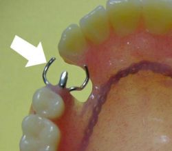 義歯の歯に引っかける部分