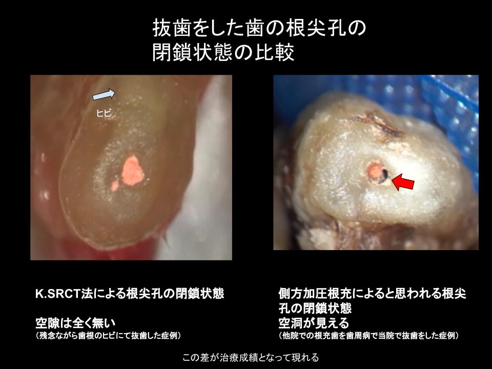 抜歯をした歯の根尖孔の閉鎖状況の比較
