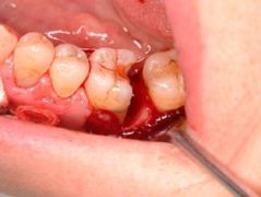 エムドゲイン使用前の歯の状態