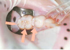 歯髄に迄達した虫歯