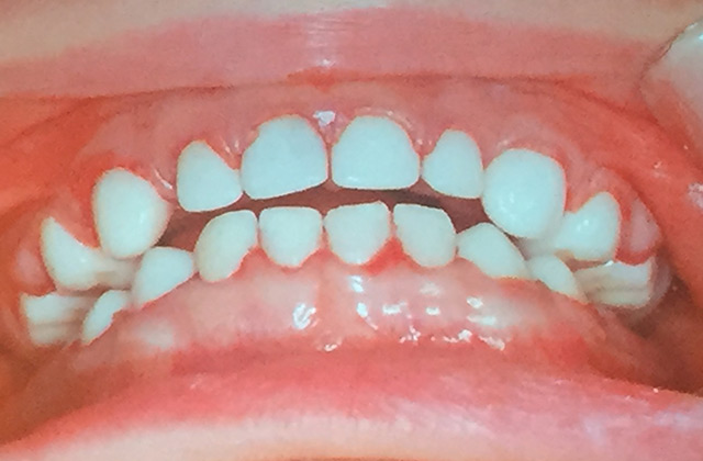 ジルコニアの白い乳歯冠